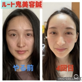 ルート鍼灸治療院ほむら ルート鬼美容鍼のメニュー画像