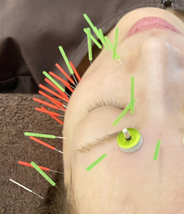 鍼灸サロン SHINSHIN Lab 豪徳寺 ■美顔鍼のメニュー画像