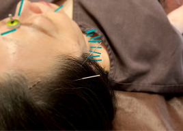 鍼灸サロン SHINSHIN Lab 豪徳寺 ■集中改善コース【美顔鍼4回コース】のメニュー画像