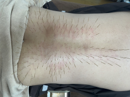 彩り はりきゅう ルート治療認定院 ルート治療 90分のメニュー画像