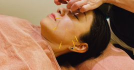 アロリエクリニック（院内セラピールーム） 美容鍼灸（お顔と全身の鍼灸）のメニュー画像