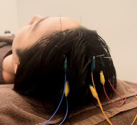 本格鍼灸院 HARI MAGIC代官山 脳ストレス解消/快眠鍼　(頭頂パルス）のメニュー画像
