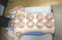 上尾よもぎ鍼灸院 カッピングのメニュー画像