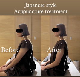 Acu-pa鍼灸院（アキュパ） 首肩こり・姿勢改善トリガーポイント鍼治療のメニュー画像