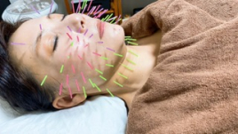 上尾よもぎ鍼灸院 美容鍼灸(レディース・メンズ)のメニュー画像