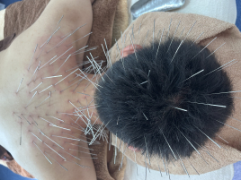 鍼灸サロンacus（アクス）ルート鍼治療専門 ルート鍼治療（60分）3~4ヶ所のメニュー画像