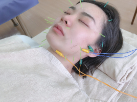 かみやま鍼灸整骨院 電気美容鍼コースのメニュー画像