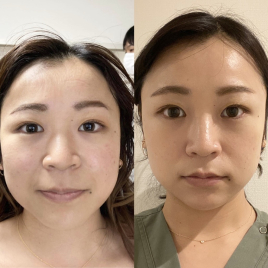salon de moe -azabu- 美容鍼コースのメニュー画像