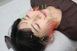 メディカルジャパン国分寺　鍼灸院　整骨院 美容鍼灸のメニュー画像