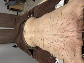 鍼灸サロンacus（アクス）ルート鍼治療専門 ルート鍼治療90分（顔＋全身）のメニュー画像