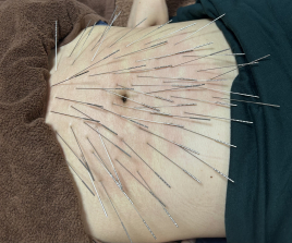 鍼灸サロンacus（アクス）ルート鍼治療専門 不妊ルート鍼治療（1回）のメニュー画像