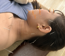 CHI-TOMA~はりきゅう~ 美容鍼灸全身コース(お顔+頭+お身体)のメニュー画像