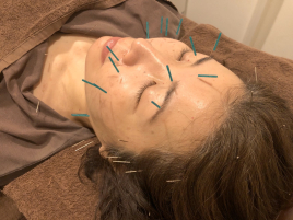 からだ研究所鍼灸整骨院 美容鍼＋マイオセラピー（60分・90分）のメニュー画像