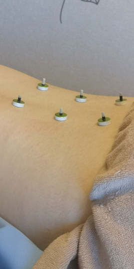 Kirschbaum鍼灸マッサージ治療院 鍼灸のメニュー画像