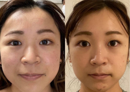 相澤治療院　〜ルート治療認定院〜 ルート鬼美容鍼のメニュー画像