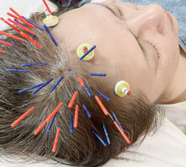 鍼灸サロン　la mer 女性の抜け毛ケアコースのメニュー画像