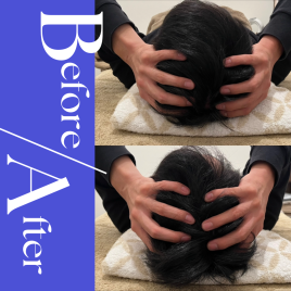 美容鍼灸サロンAimer 頭鍼ヘッドスパ　30分コースのメニュー画像
