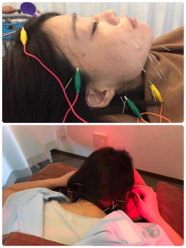 鍼灸＆ボディケアサロン大濠ベッラ 美容鍼と身体を治す鍼灸のメニュー画像