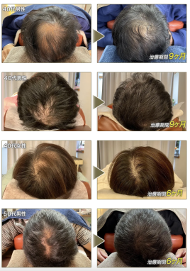 大人と子どもの鍼灸院　鍼助（はりすけ） 薄毛育毛のメニュー画像