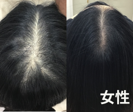 美容鍼・薄毛専門　はりきゅっと鍼灸院 【新規限定価格】薄毛・抜け毛・産後専門のメニュー画像