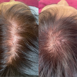 KIYO 美容鍼鍼灸マッサージ治療院 毛髪再生幹細胞ダーマ鍼®のメニュー画像