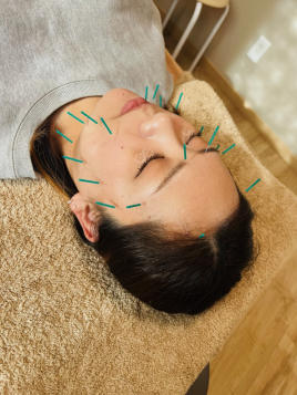 かまだ鍼灸整骨院 １番人気！【美容鍼】スタンダードコースのメニュー画像