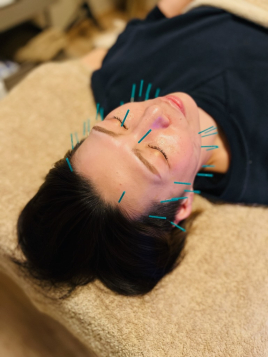 かまだ鍼灸整骨院 【美容鍼】スペシャルコースのメニュー画像