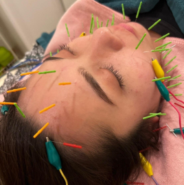 鍼灸 玉兎治療院 幹細胞ポレーション導入美容鍼のメニュー画像