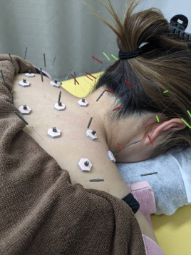 たきがみ鍼灸整骨院 鍼灸治療のメニュー画像