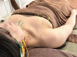 鍼灸サロンflat ◆小倉駅から徒歩5分の美容鍼灸専門サロン◆ 小顔美容鍼＆バストアップ美乳鍼のメニュー画像