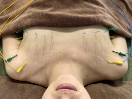 鍼灸サロンflat ◆小倉駅から徒歩5分の美容鍼灸専門サロン◆ バストアップ美乳鍼のメニュー画像