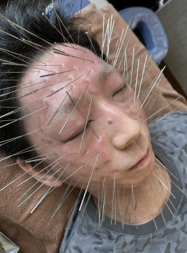 【ルート治療専門鍼灸院】鍼侍 鬼美容鍼のメニュー画像