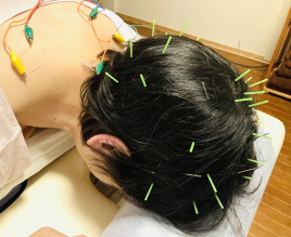 CORAL_acu女性専門鍼灸サロン 女性のための育毛鍼【美髪育毛鍼】のメニュー画像