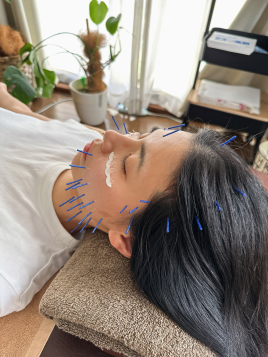 【ダイエット・育毛鍼】鍼灸院Roots　宝塚院 たるみ、むくみ解消の美容鍼のメニュー画像