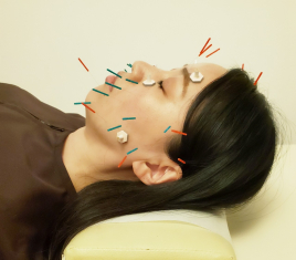 はり灸心音 顔のむくみ・たるみ改善！美容鍼灸のメニュー画像