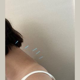 鍼灸ととの麻 美容鍼灸のメニュー画像