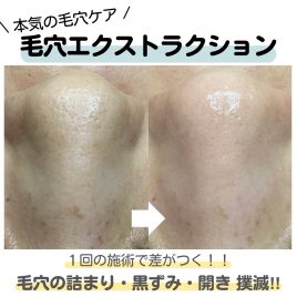 in Filaka鍼灸マッサージ院 毛穴エクストラクションのメニュー画像