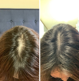 さき鍼灸院 薄毛鍼灸のメニュー画像