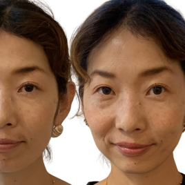 池袋いしはら鍼灸院 美容鍼のメニュー画像
