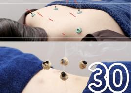 Halimelia（ハリメリア） 鍼灸30分のメニュー画像