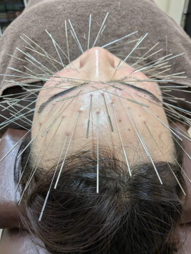 鍼灸接骨院てあて ルート治療【鍼】のメニュー画像
