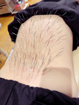 女性専門えびす鍼灸整骨院　〜女性の為のルート鍼治療〜 ルート鍼治療もしくは空ルート＝30分のメニュー画像