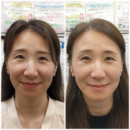 三郷駅前はりきゅう整骨院 美容鍼　小顔/たるみケア/ハリのメニュー画像