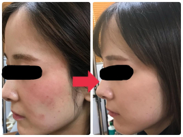 あかぬま鍼灸治療院 アトピー性皮膚炎、アレルギー性皮膚炎のメニュー画像