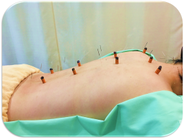 すぎの木鍼灸院 全身施術のメニュー画像