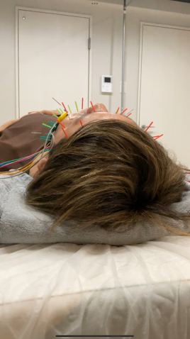 alpha（アルファ）鍼灸院 美容鍼オプション　毛穴レスハリネズミ鍼のメニュー画像