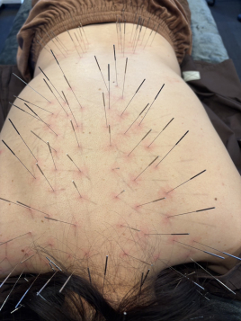 女性専門えびす鍼灸整骨院　〜女性の為のルート鍼治療〜 ルート鍼治療＋空ルート＝90分のメニュー画像