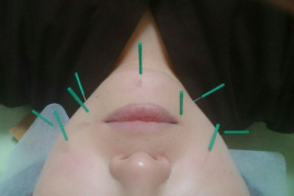 森羅EBISU　MEDICAL＆BEAUTY　CENTRE 美容鍼のメニュー画像