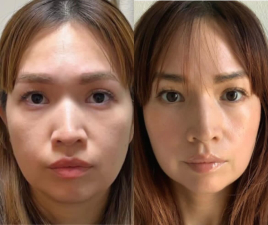 鍼処FUJINUMA ルート鬼美容鍼 15分のメニュー画像