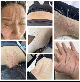 鍼処FUJINUMA ルート鍼治療 60分のメニュー画像